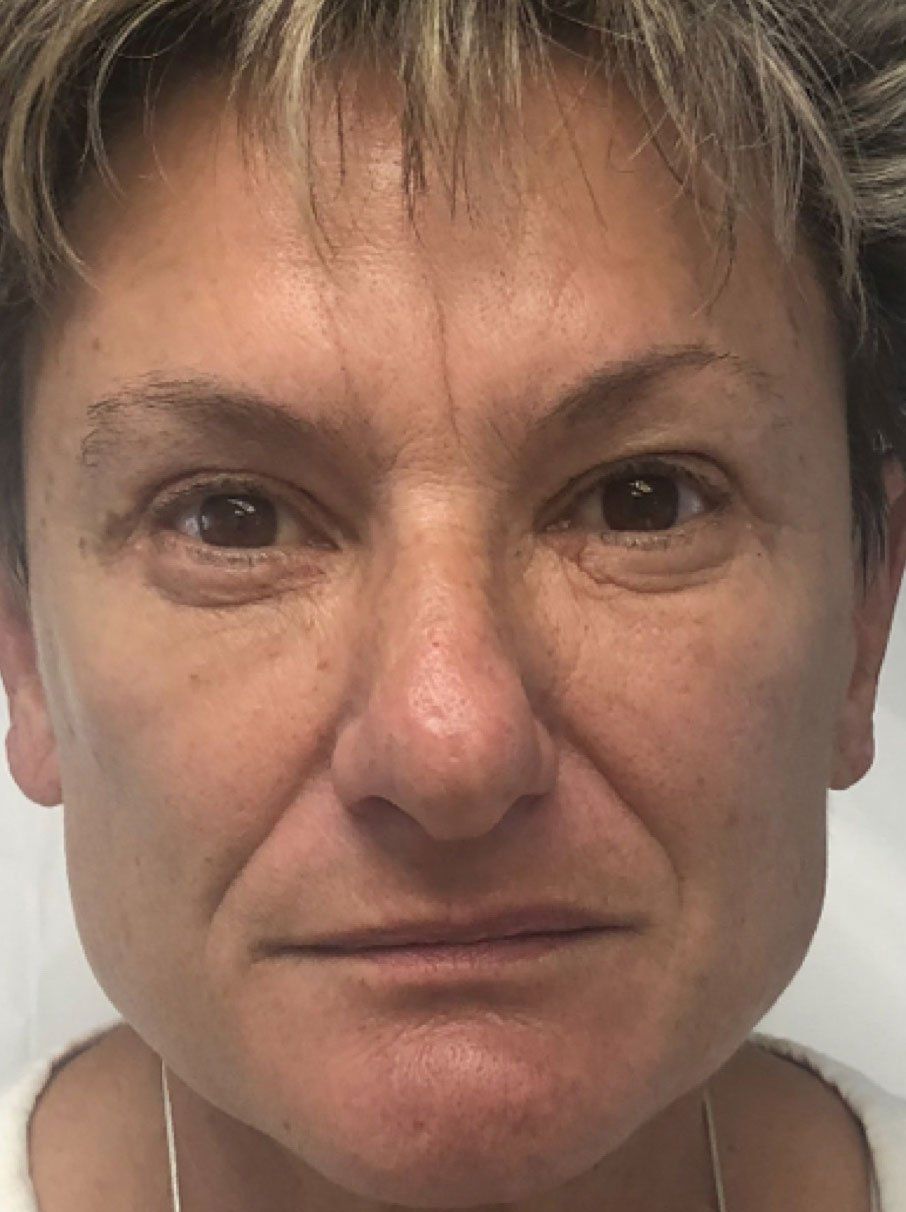 Dermal Fillers Before - Real Client Muskoka
