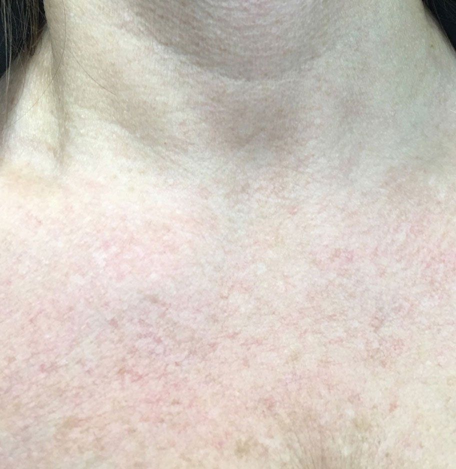 Platelet-Rich-Plasma After - Real Client Muskoka