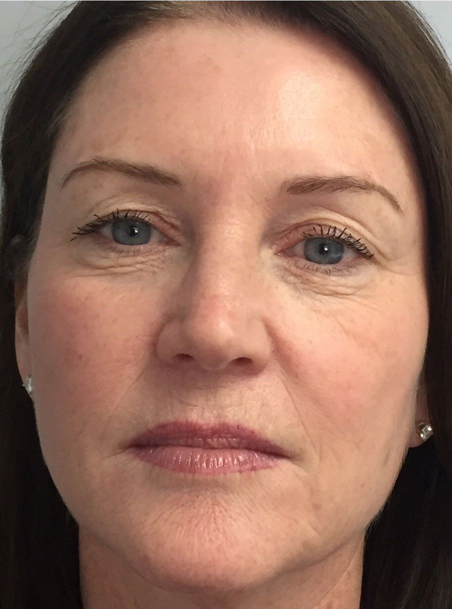 Platelet-Rich-Plasma After - Real Client