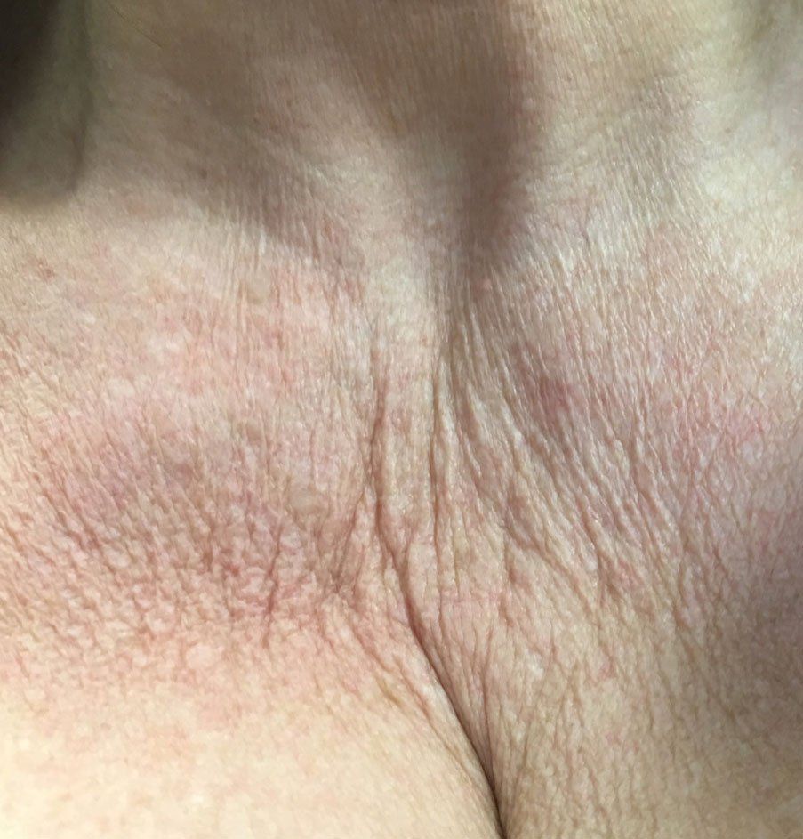 Platelet-Rich-Plasma Before - Real Client Muskoka