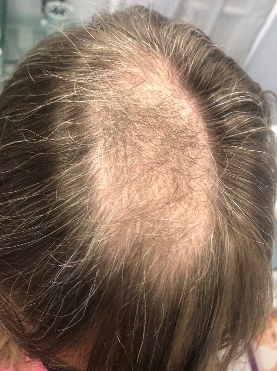 Platelet-Rich-Plasma Before - Real Client Muskoka