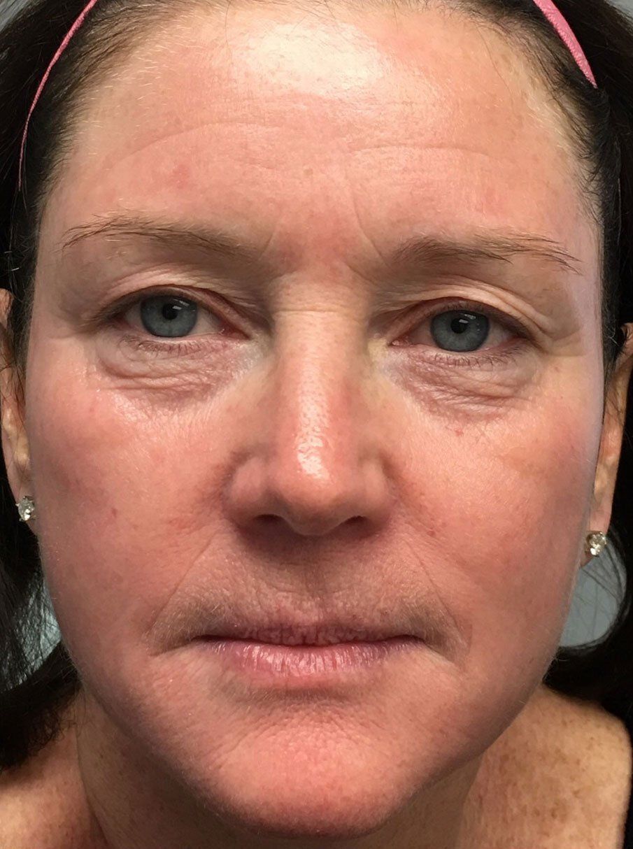 Platelet-Rich-Plasma Before - Real Client Muskoka