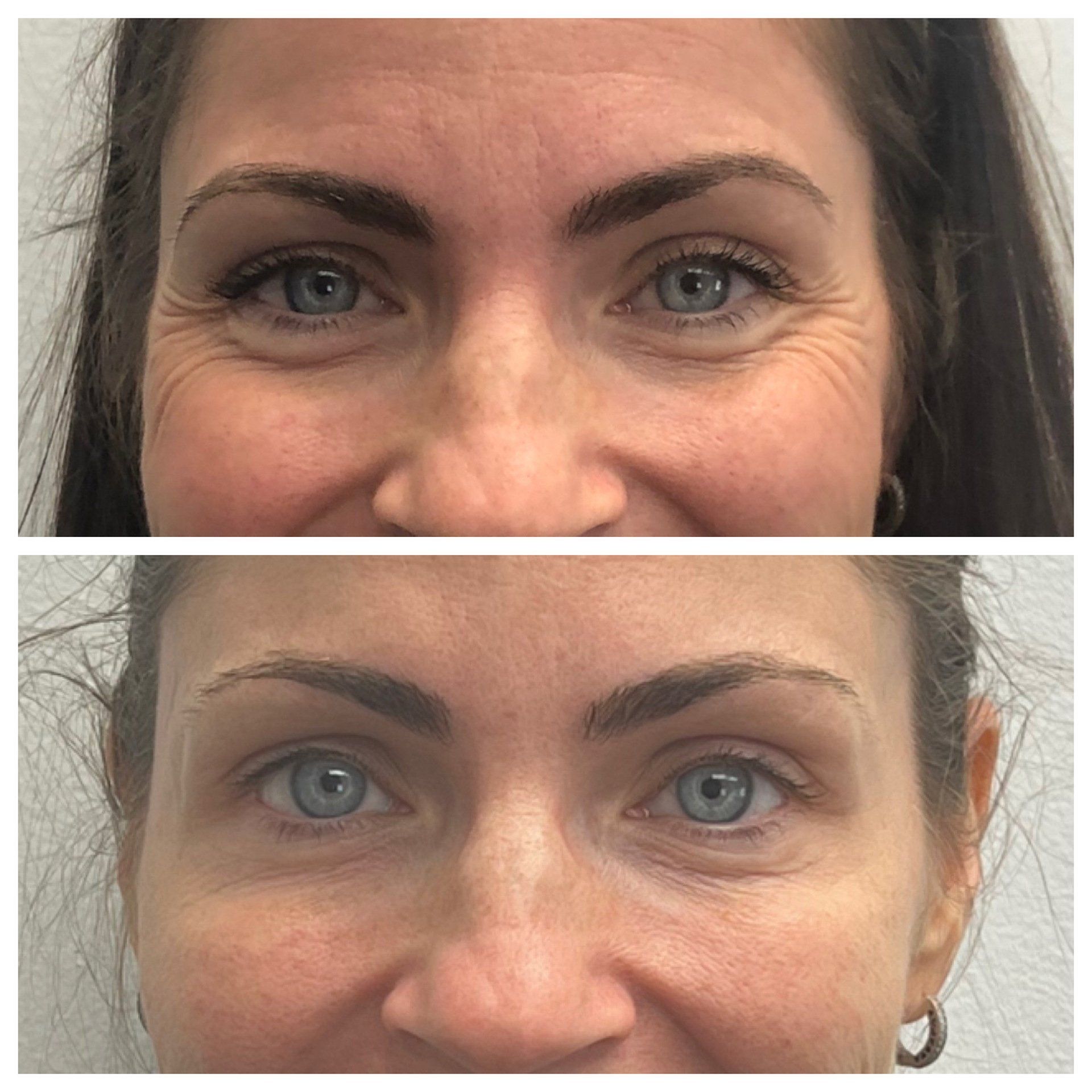 Botox Before and After - Real Patient Ajax