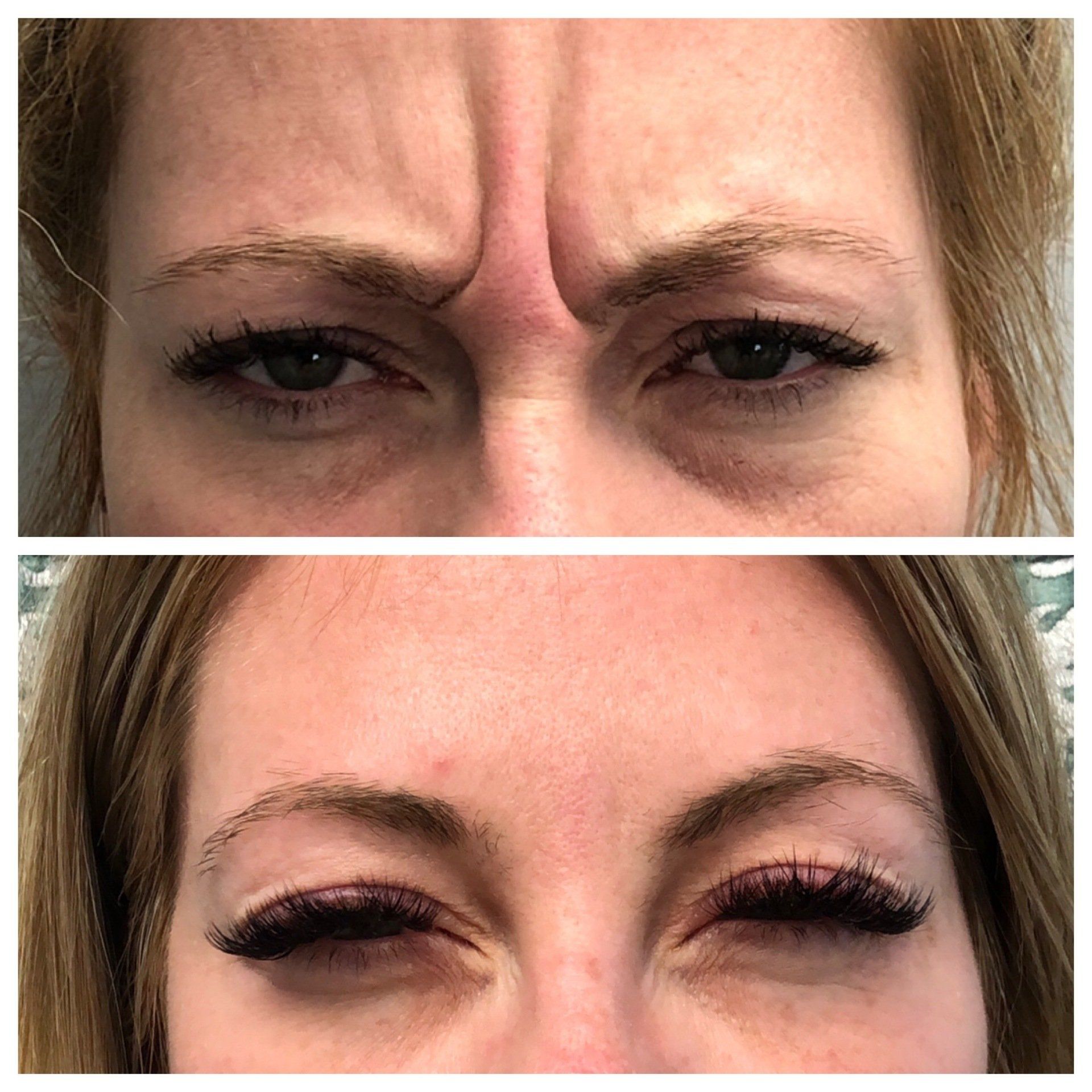 Botox Before and After - Real Patient Durham
