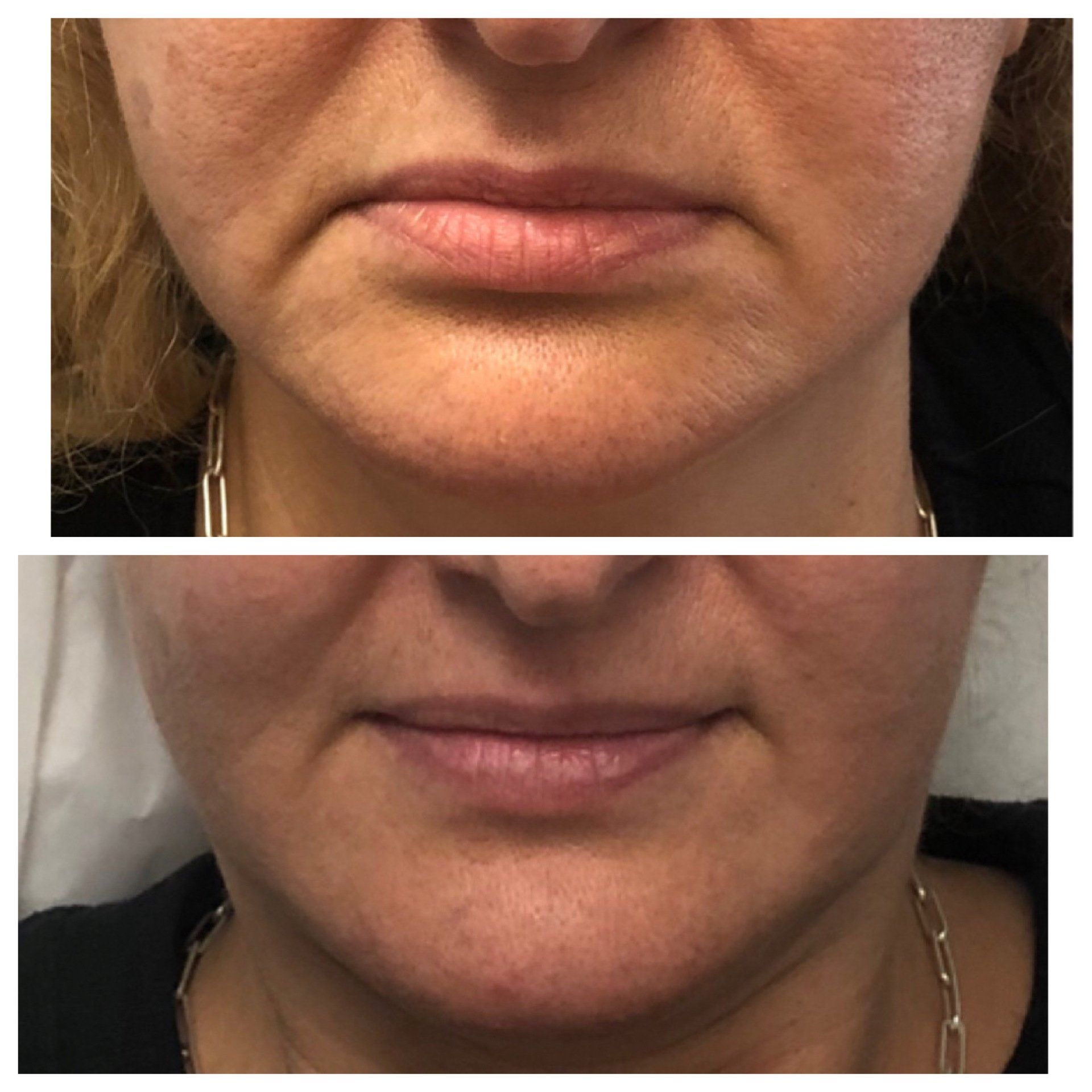 Botox Before and After - Real Patient Muskoka