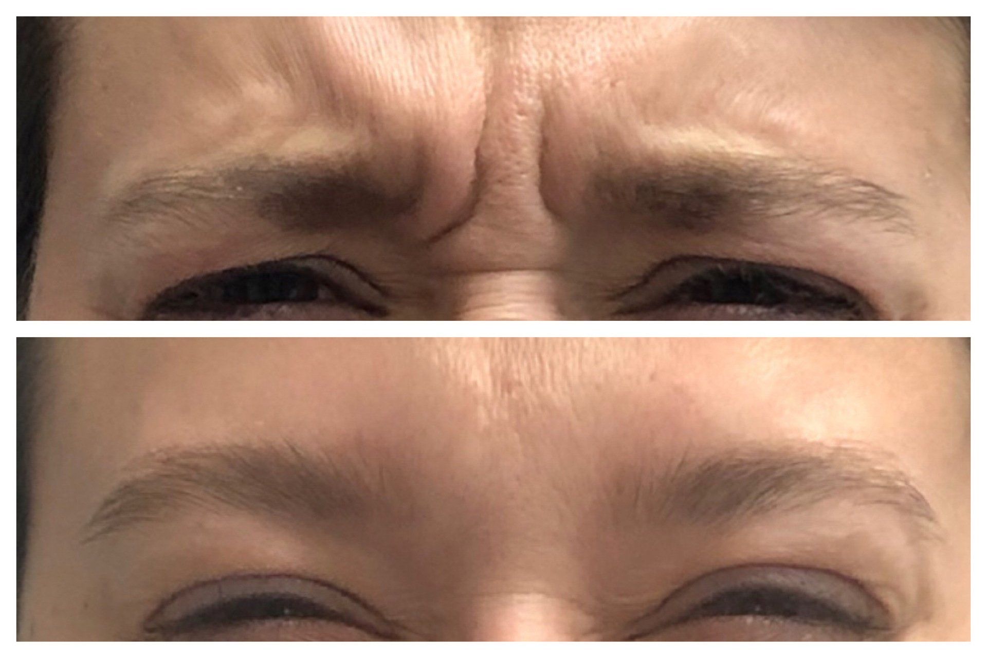 Botox Before and After - Real Patient Port Carling