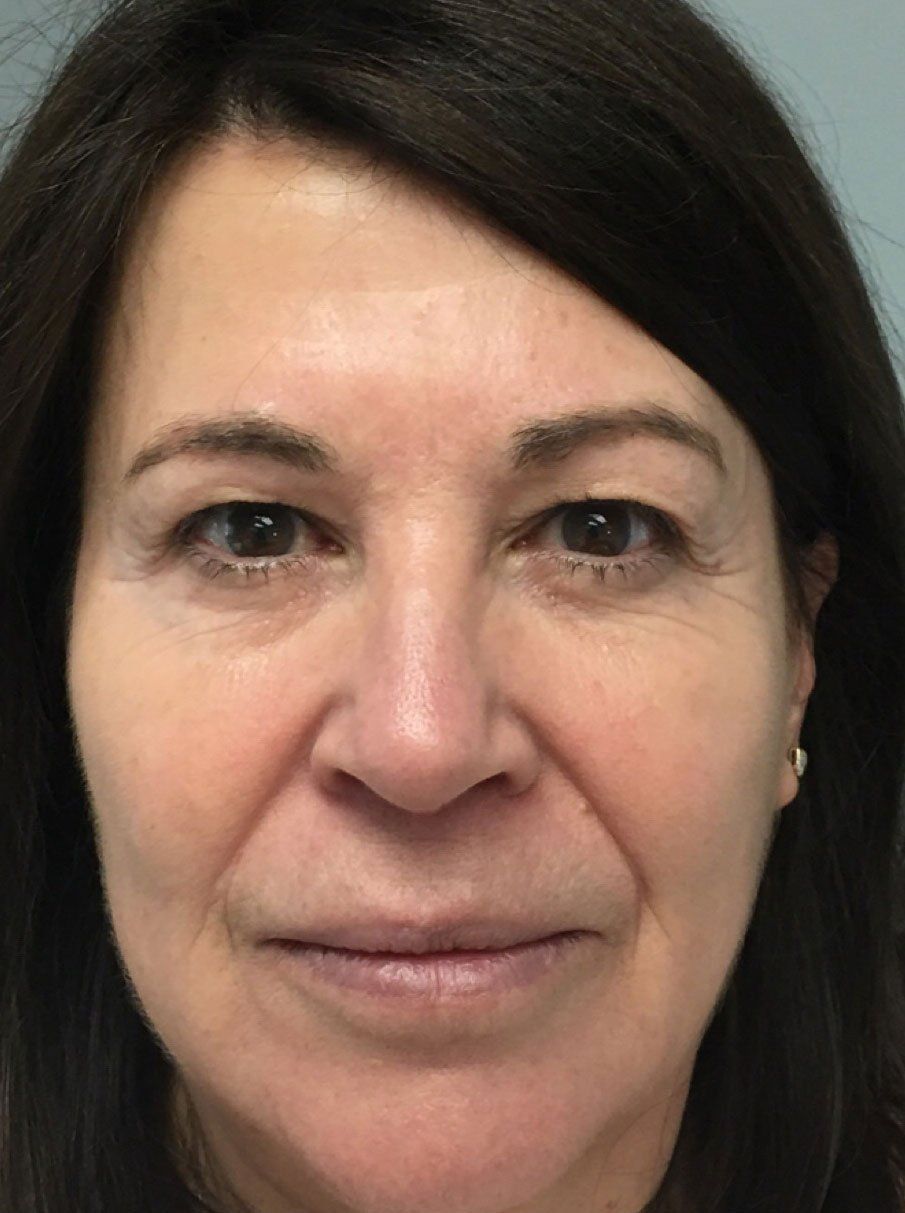 Dermal Fillers After - Real Client Durham