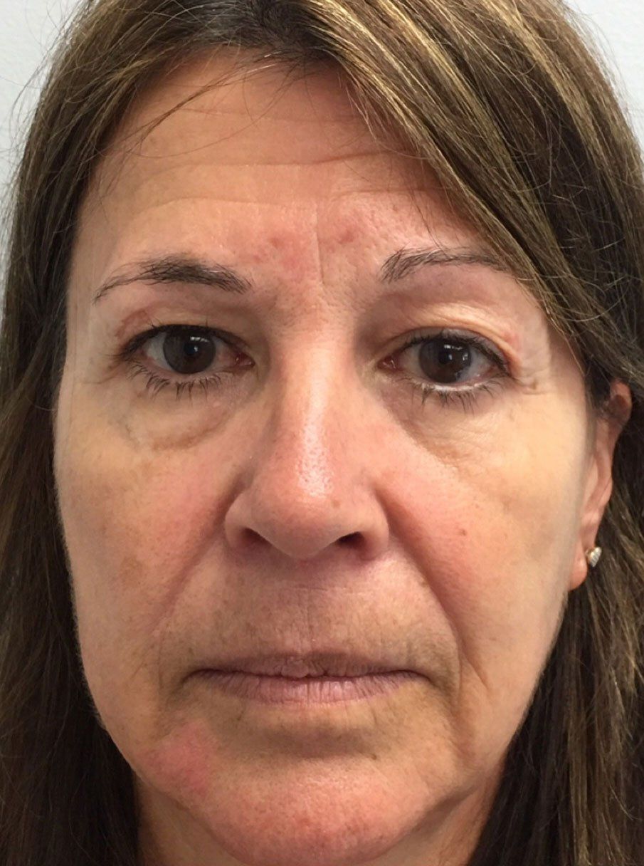Dermal Fillers Before - Real Client Durham