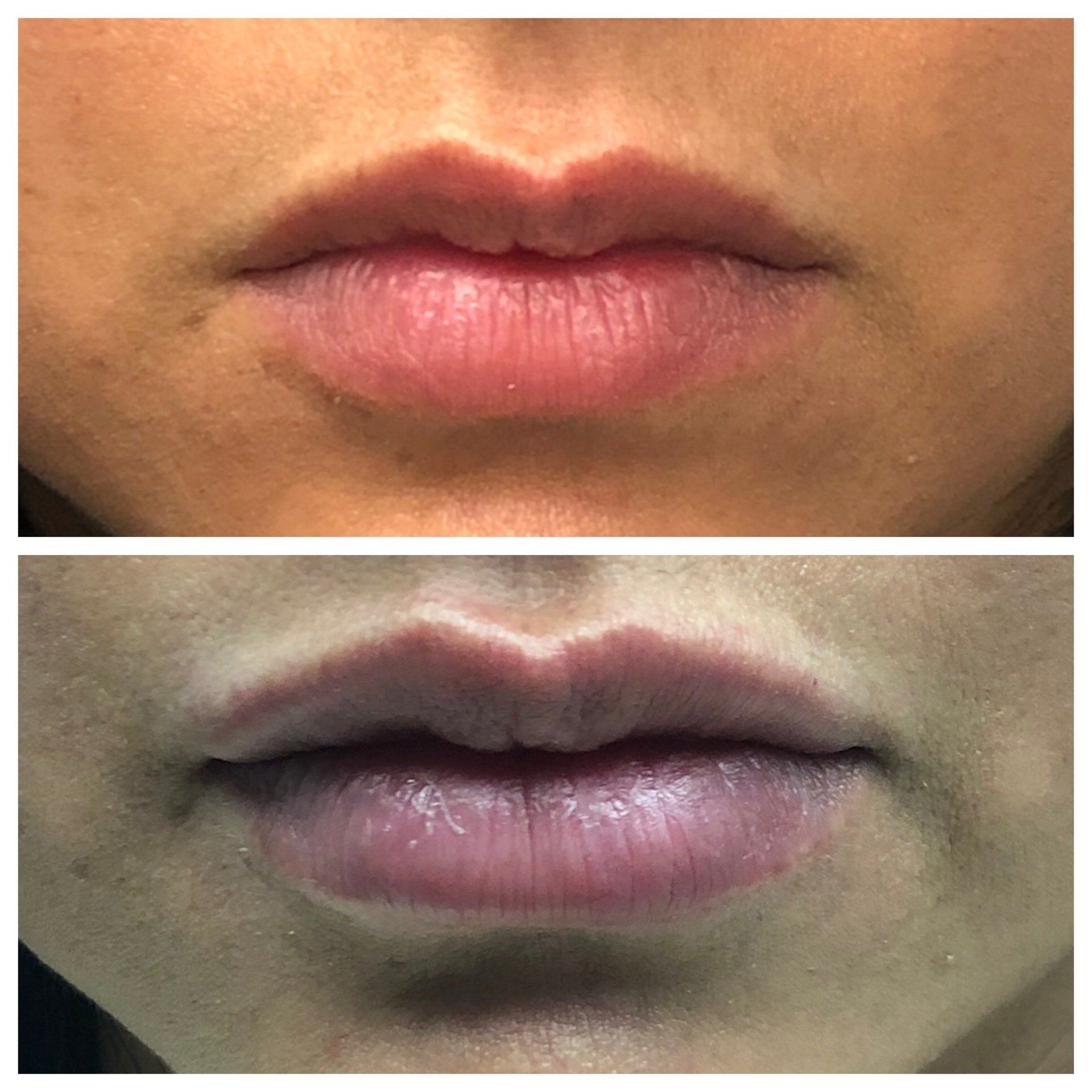 Lip Filler Procedure Durham