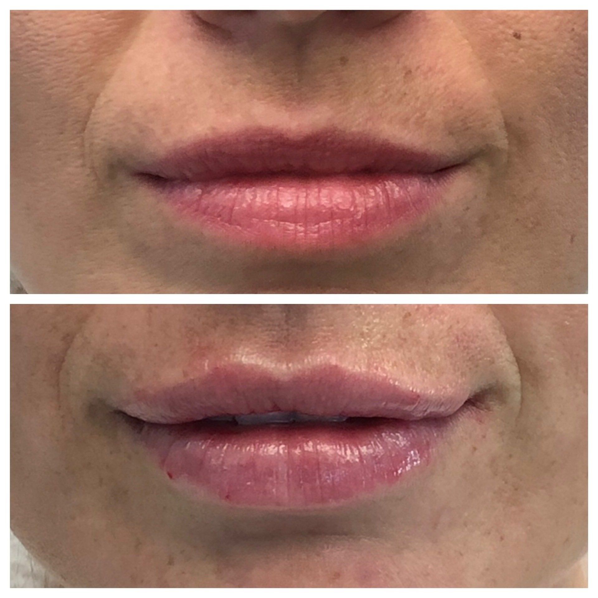 Cosmetic Lip Filler Muskoka