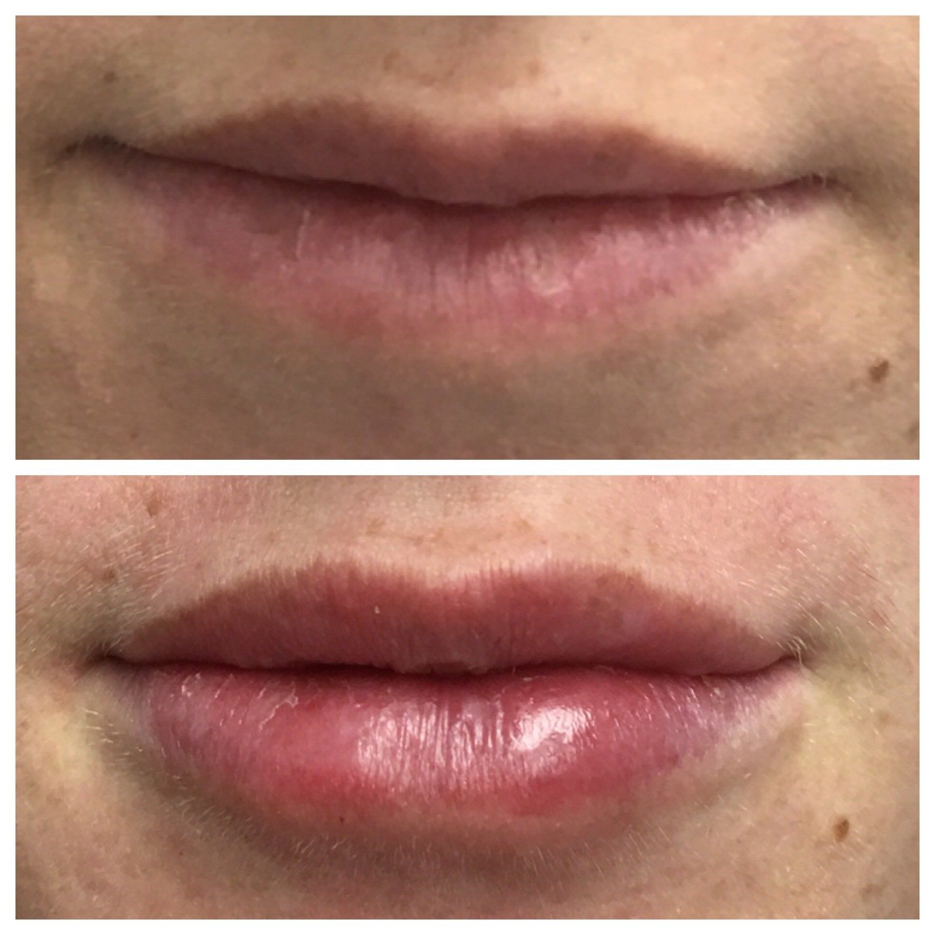 Lip Filler Procedure Muskoka