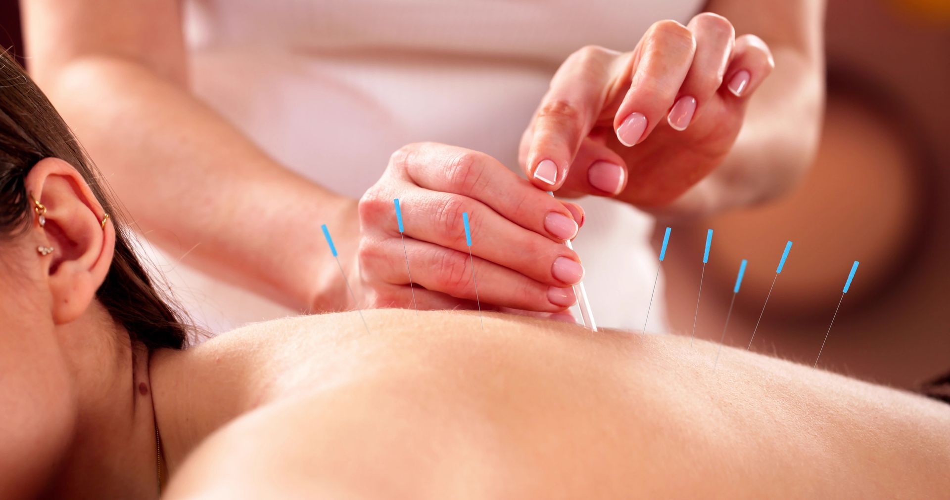Acupuncturist inserting needles into a patient's back. Hands, needles, and skin are visible.