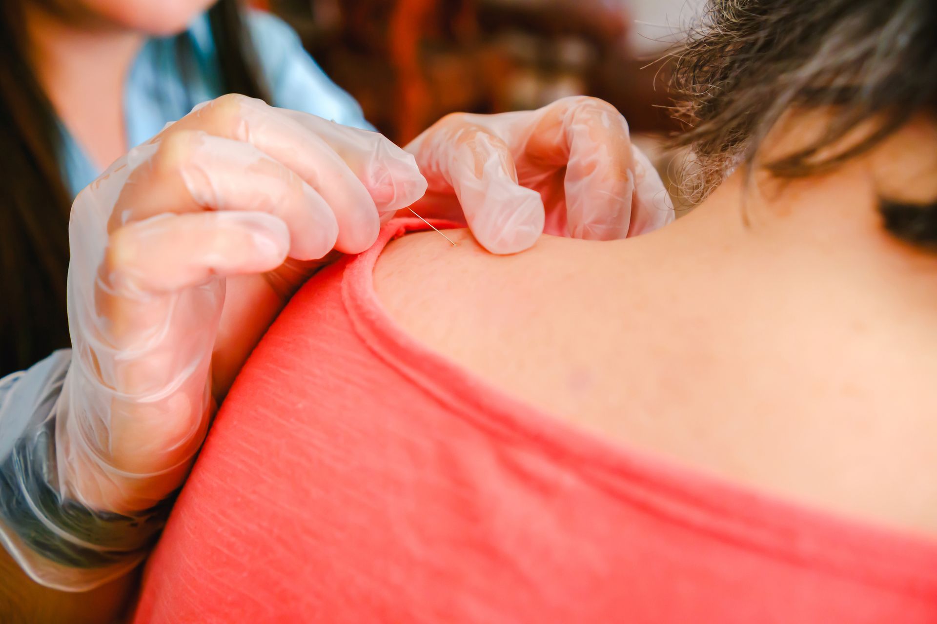 Gloved hands examining a mole on a person's shoulder, in a medical setting.