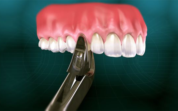 Extractions