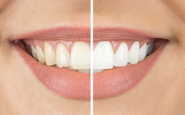 Teeth Whitening
