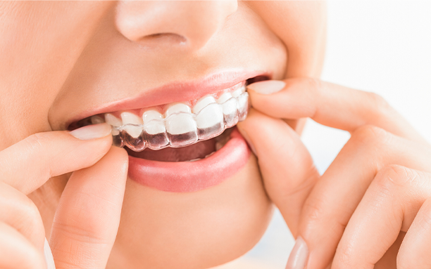 Invisalign
