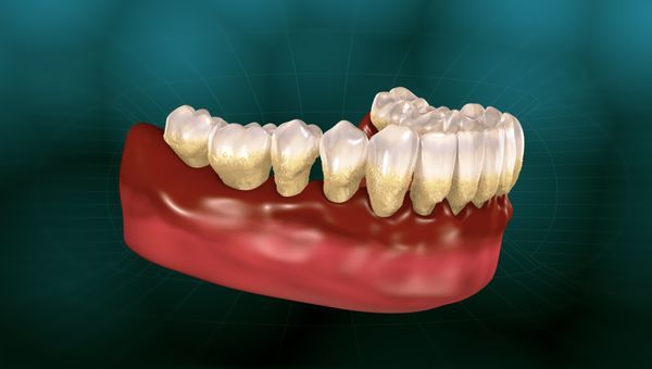 Periodontitis