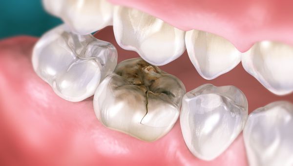 Cracked Tooth