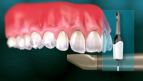 Clear Aligner Technology (CAD/CAM)