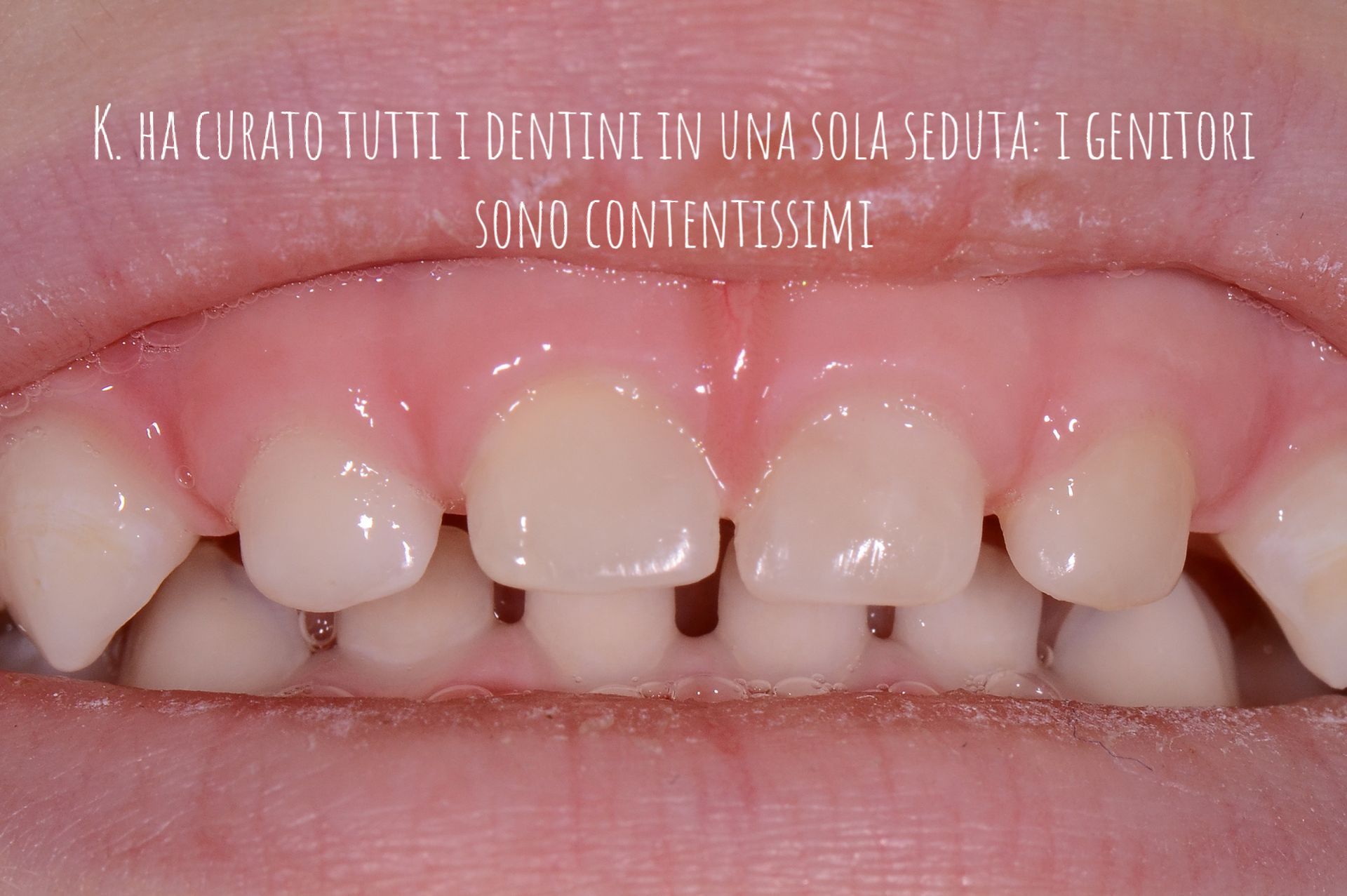 Primo piano di una bocca sorridente con i denti incisivi superiori leggermente irregolari e gengive rosa visibili.