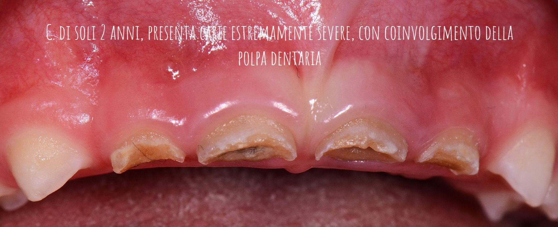 Primo piano dei denti frontali superiori con carie giallo-marrone ed erosione dello smalto vicino alle gengive.