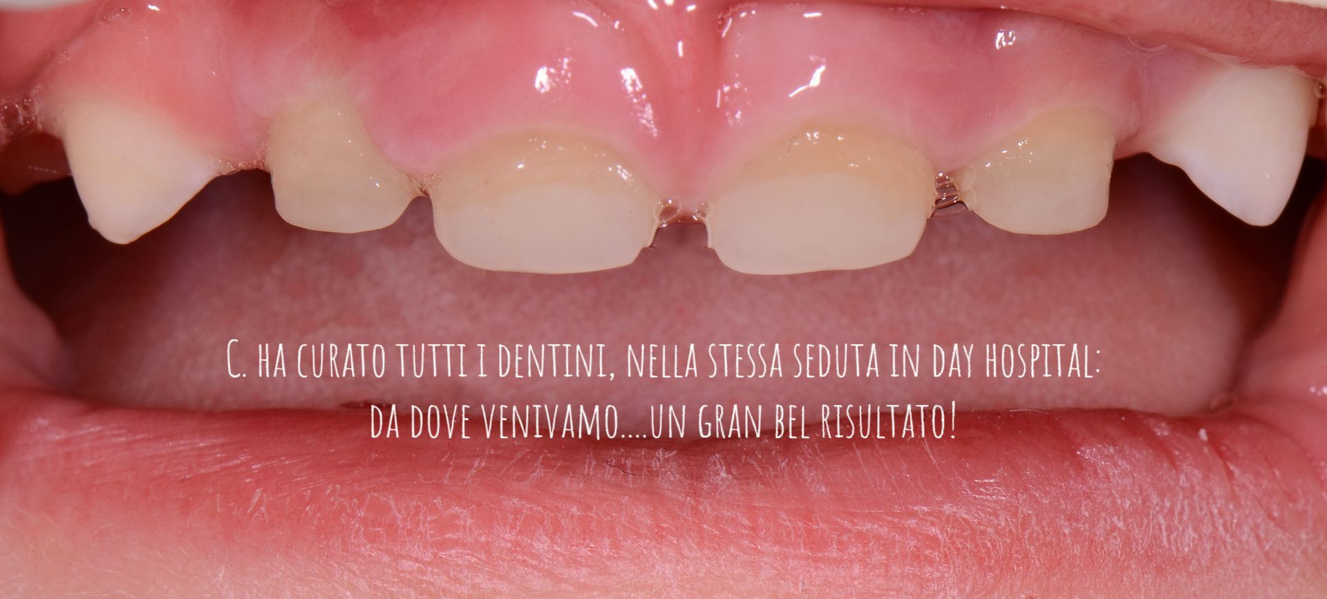 Primo piano dei denti superiori di un bambino con indicazione dello spazio tra gli incisivi e piccolo testo sovrapposto in basso.