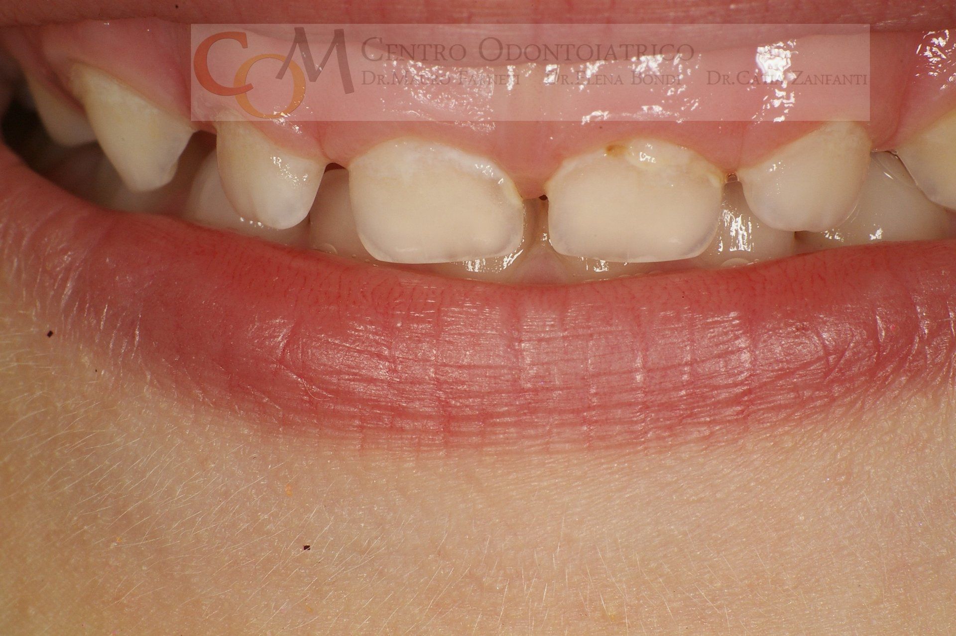 Primo piano di una bocca sorridente che mostra i denti incisivi superiori con spazi vuoti e allineamento irregolare.