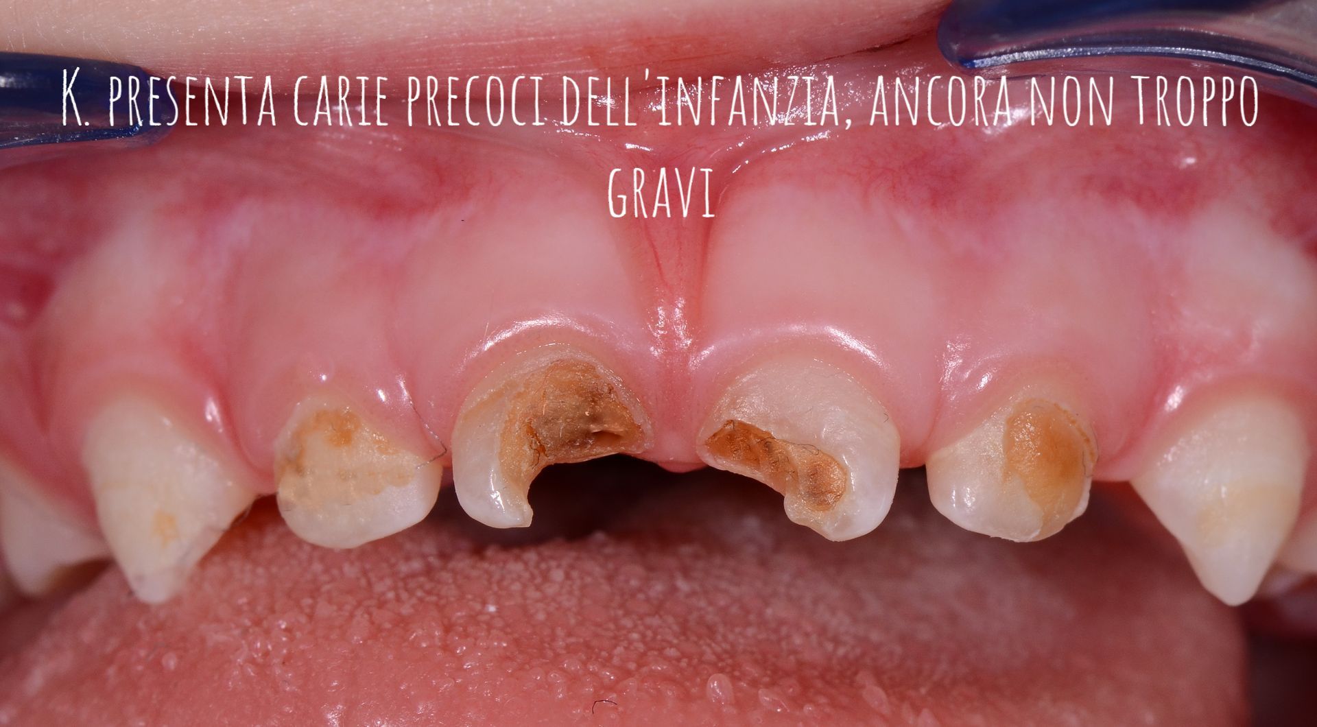 Primo piano dei denti frontali superiori con carie grave e dente centrale mancante, che mostrano cavità marroni su gengive rosa.