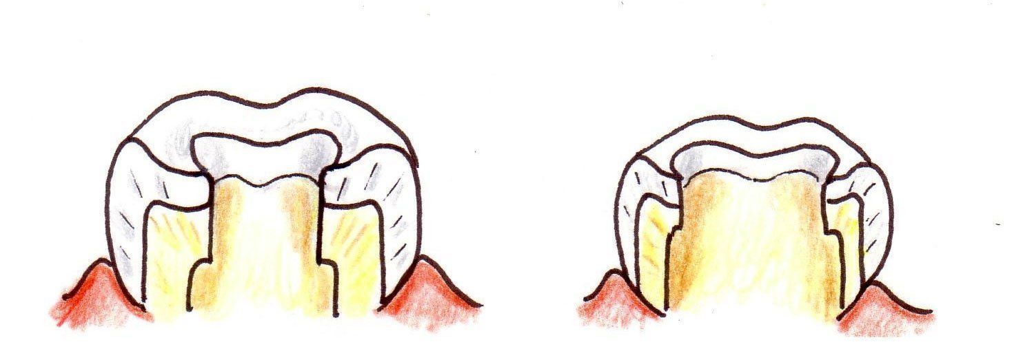 Due diagrammi di denti affiancati che mostrano gengive rosse e infiammate intorno alle radici, uno dei quali con una recessione gengivale più grave.