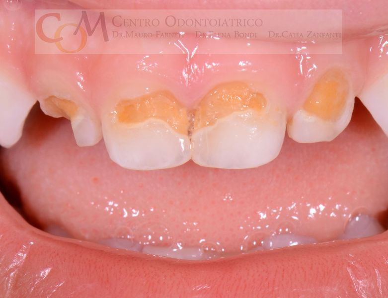 Primo piano dei denti frontali superiori con scolorimento dello smalto giallo-arancio e scheggiature.