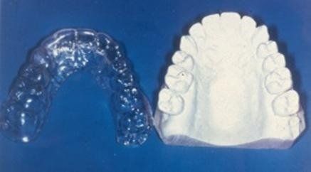 Impronte dentali chiare e bianche affiancate su sfondo blu.