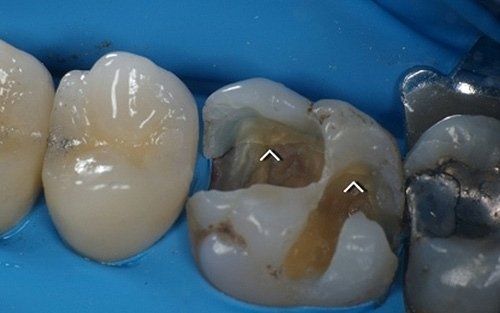 Primo piano di denti con otturazioni e carie su due molari su sfondo blu.