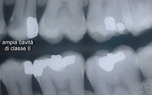 Radiografia dentale dei molari che mostra grandi carie di classe II etichettate in italiano
