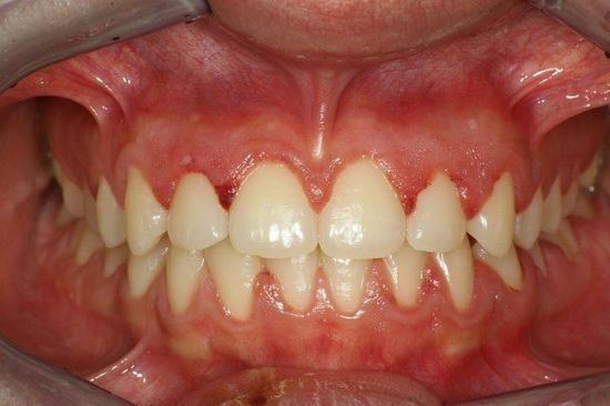 Primo piano dei denti frontali con incisivi inferiori affollati e disallineati e gengive rosa.