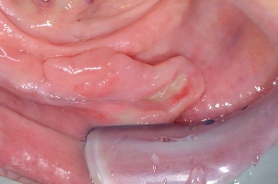 Primo piano di tessuto interno della bocca di colore rosa con una piccola ulcera bianca sulla gengiva inferiore.