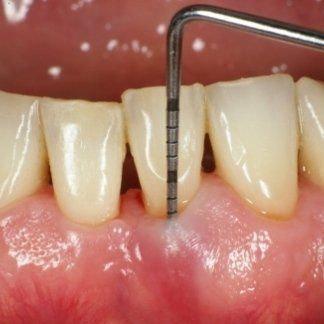 Sonda dentale per misurare la tasca gengivale tra gli incisivi