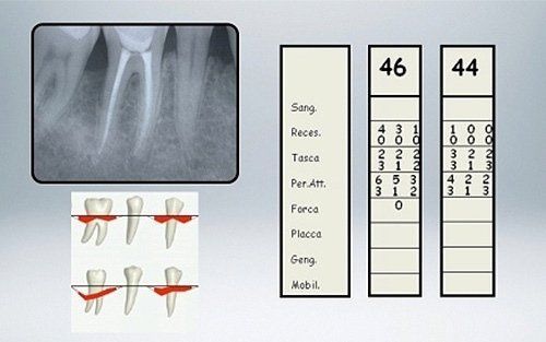 Radiografia dentale con mappa dentale e misurazioni parodontali per i denti 46 e 44.