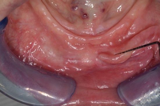 Primo piano delle gengive inferiori e della parte interna del labbro con una linea di riferimento nera e divaricatori dentali viola.