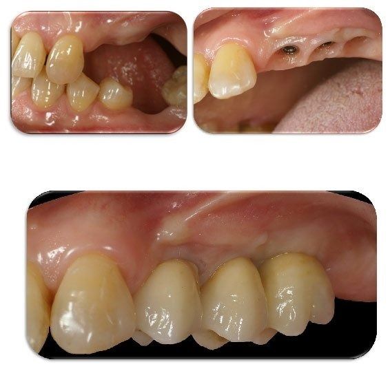 Foto dentali ravvicinate che mostrano i denti frontali superiori con spazi vuoti, denti mancanti e smalto ingiallito.