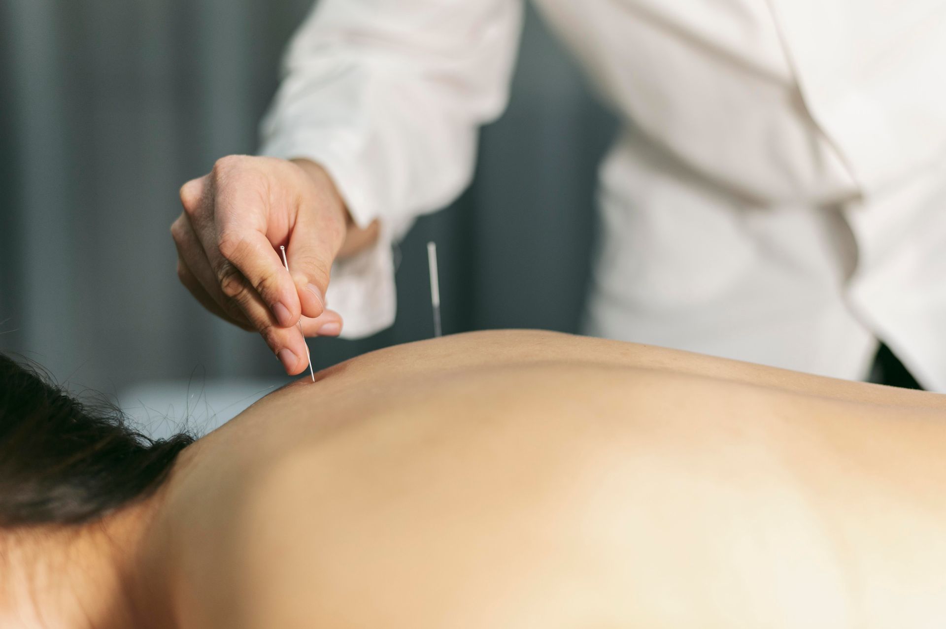 Acupuncturist placing a needle into a patient’s bare back during treatment