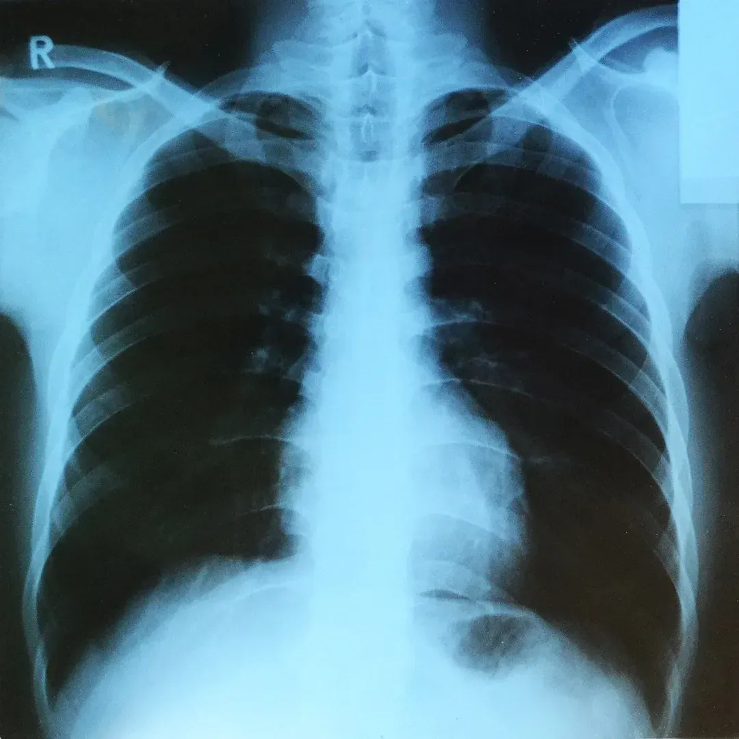 Lung X-ray — Williamson, NY — Paleopix Lung X-ray — Williamson, NY — Paleopix