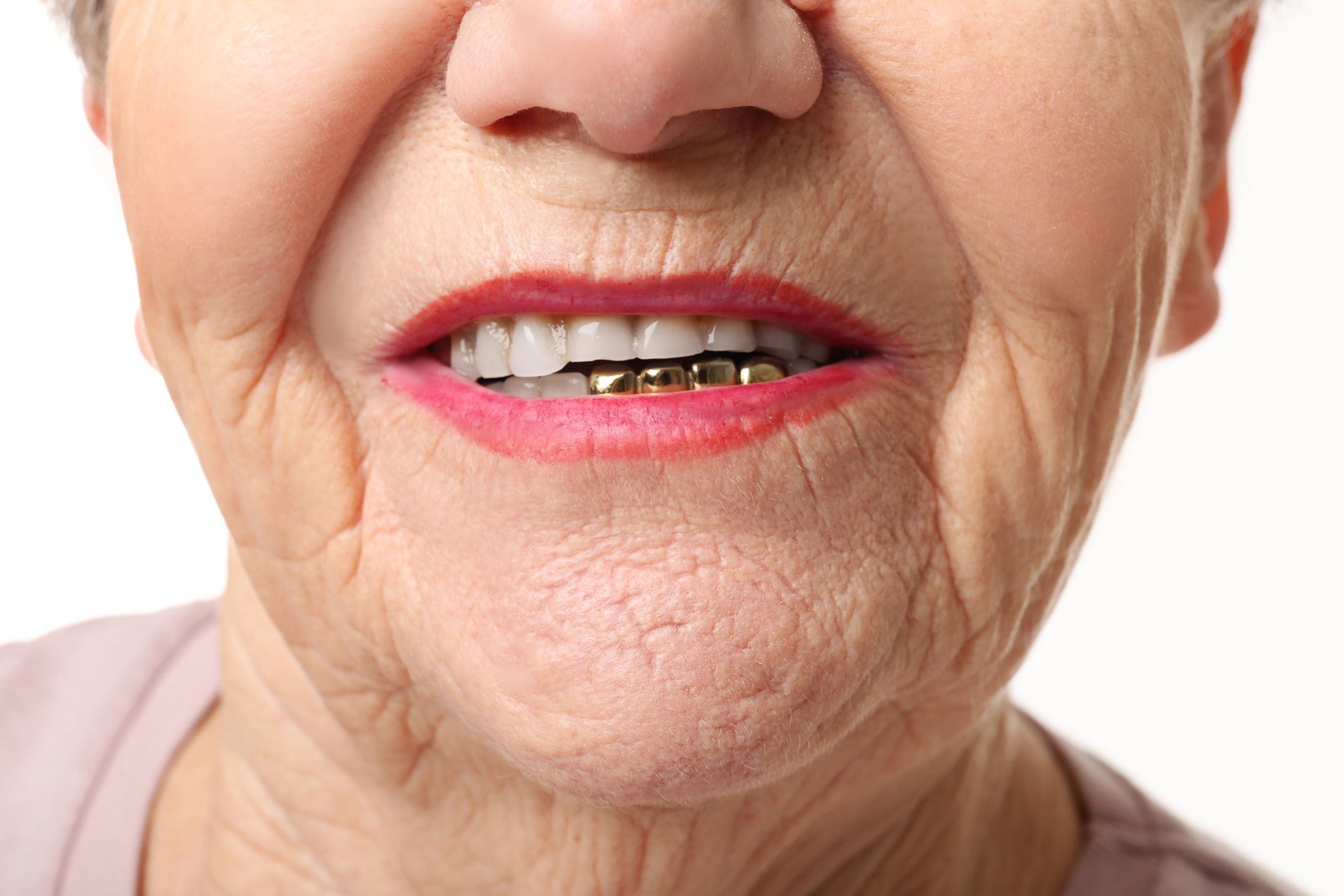 A close up of an elderly woman 's mouth with braces on her teeth.