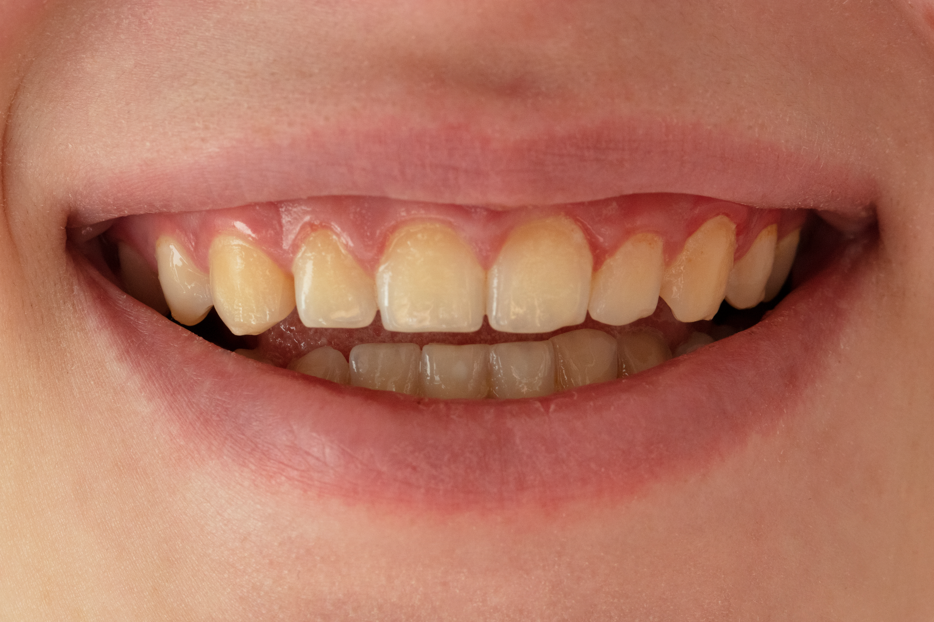 Before photo of a woman's smile