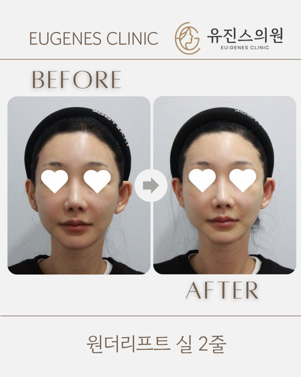 Thread lift before and after in Seoul, Wonder Lift thread lift, 2 threads, EU:GENES Skin Clinic Apgujeong