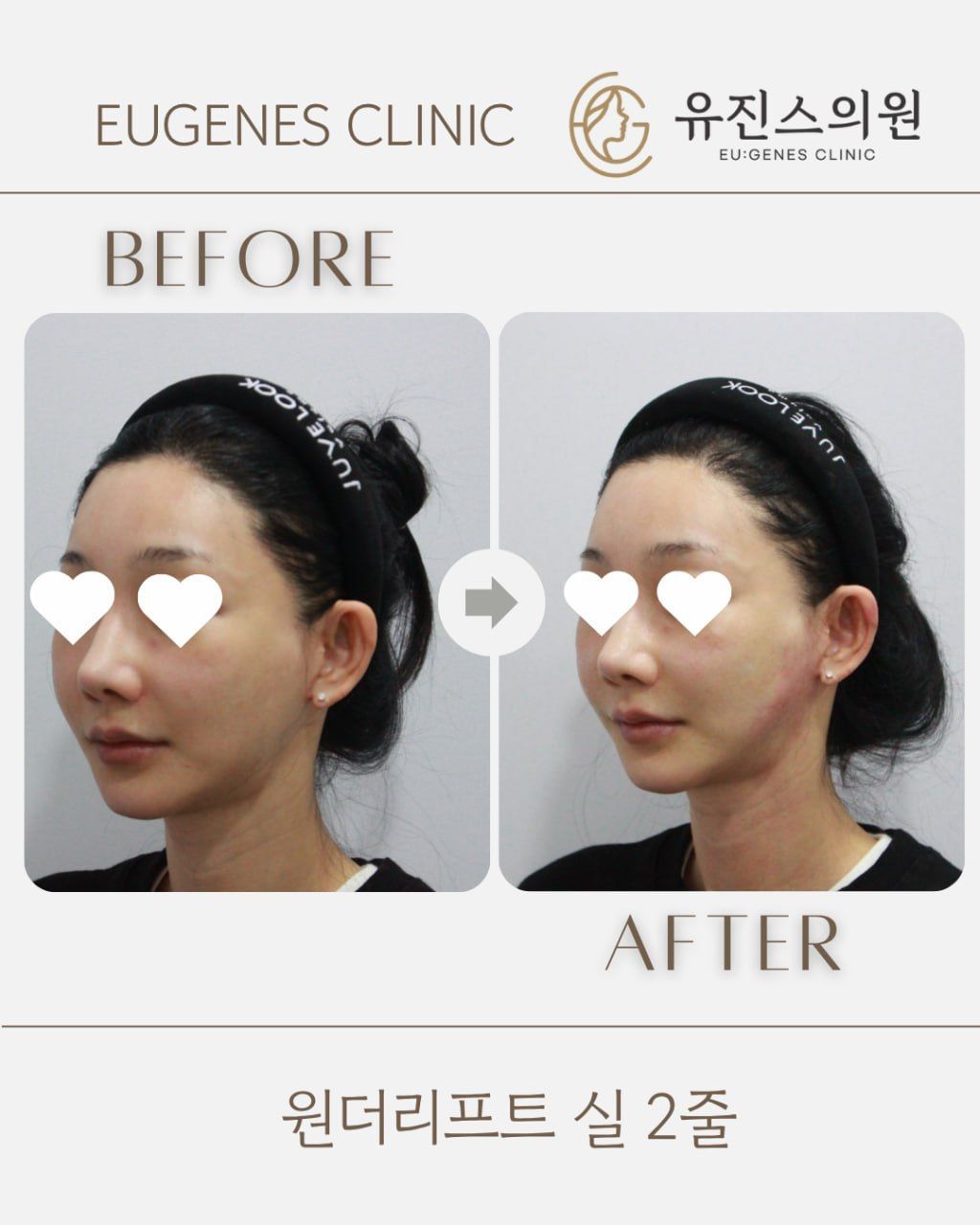 Thread lift before and after in Seoul, Wonder Lift thread lift, 2 threads, EU:GENES Skin Clinic Apgujeong
