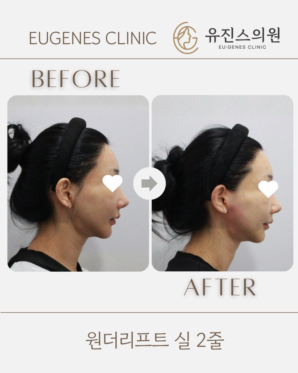Thread lift before and after in Seoul, Wonder Lift thread lift, 2 threads, EU:GENES Skin Clinic Apgujeong
