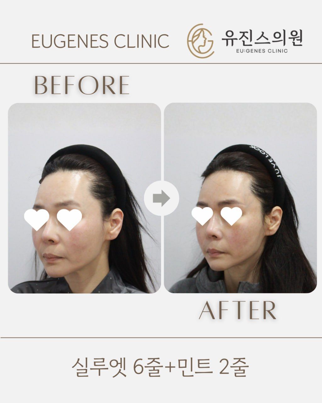 Thread lift before and after in Seoul, Silhouette Soft 6 threads + MINT 2 threads, EU:GENES Skin Clinic Apgujeong