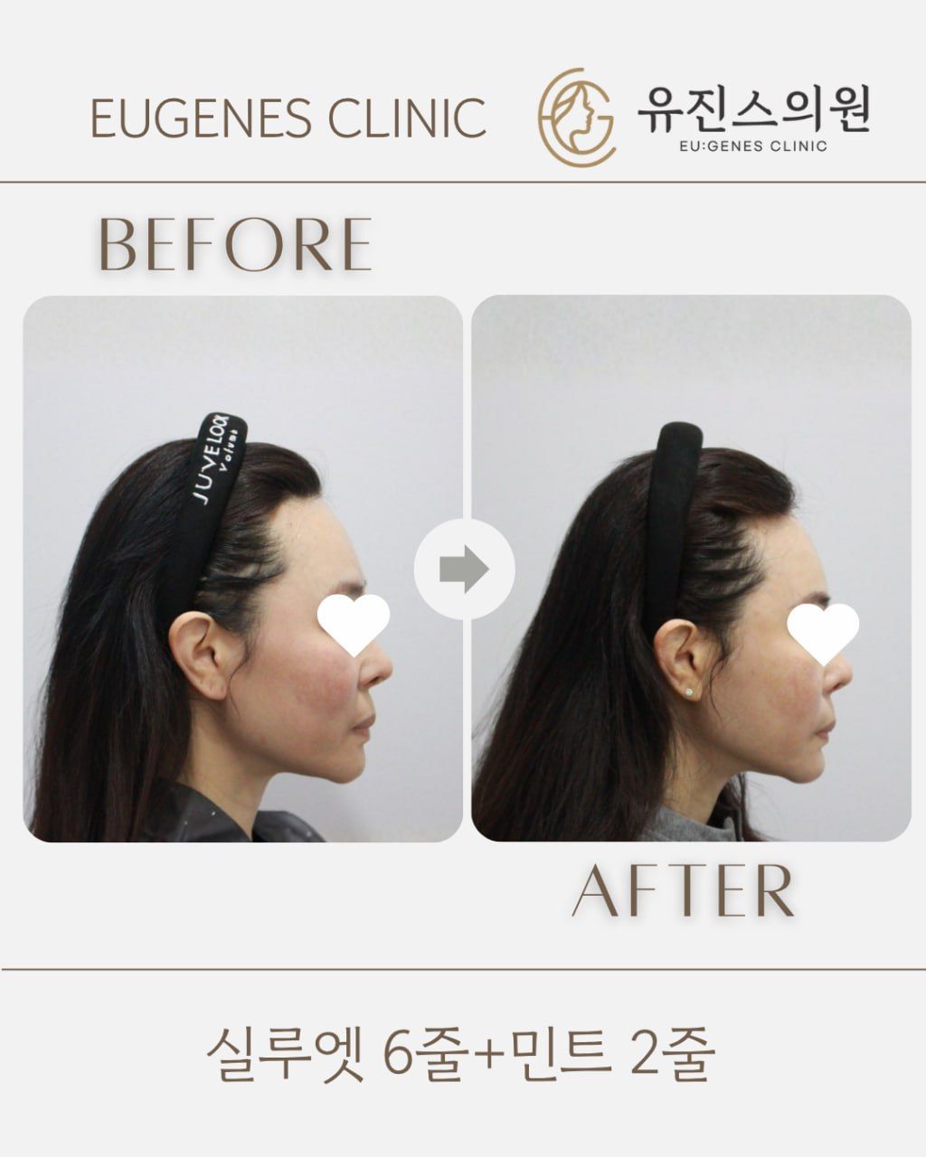 Thread lift before and after in Seoul, Silhouette Soft 6 threads + MINT 2 threads, EU:GENES Skin Clinic Apgujeong