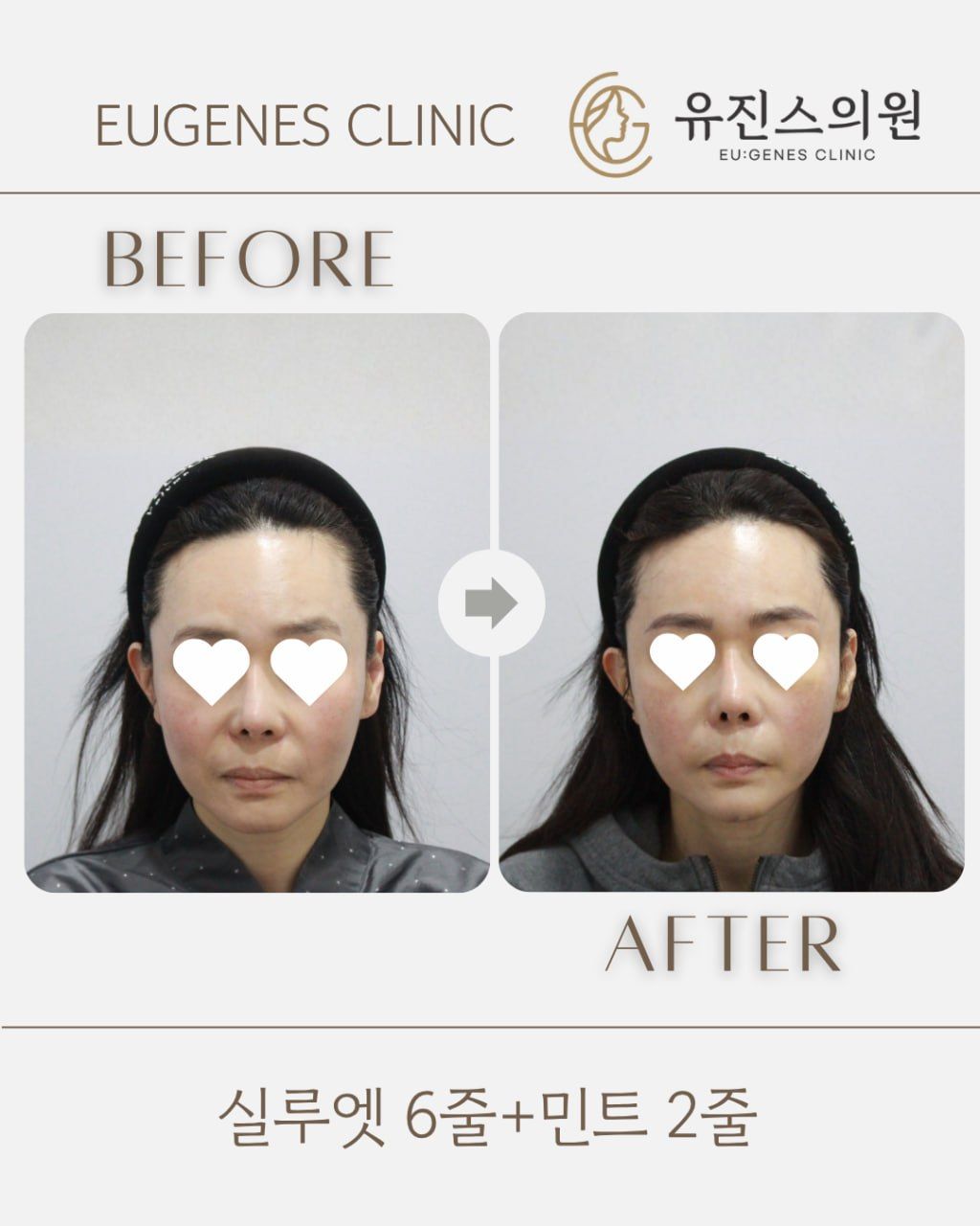 Thread lift before and after in Seoul, Silhouette Soft 6 threads + MINT 2 threads, EU:GENES Skin Clinic Apgujeong