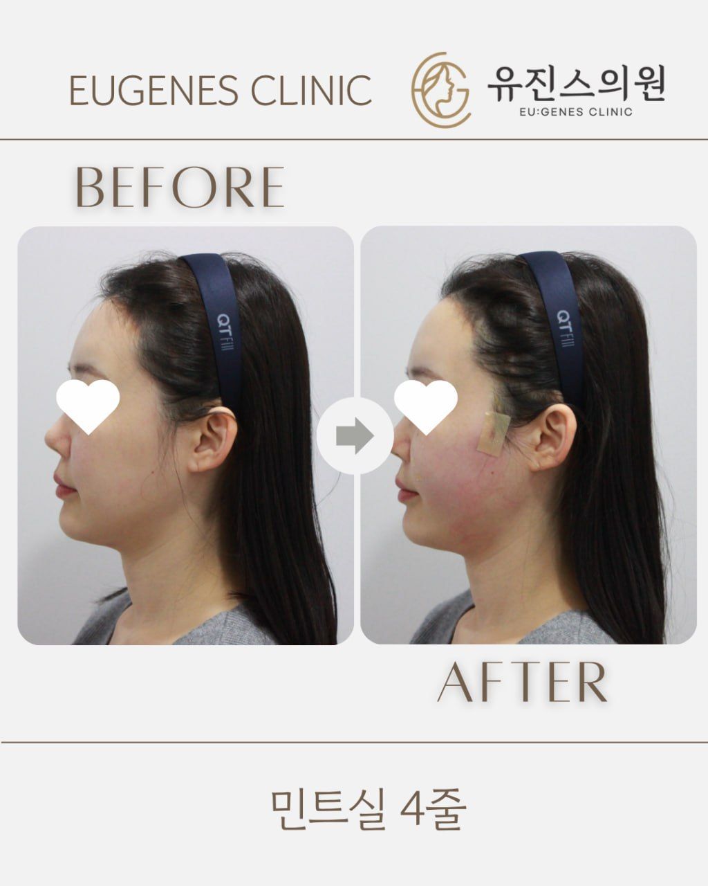 Thread lift before and after in Seoul, MINT thread lift, 4 threads, EU:GENES Skin Clinic Apgujeong